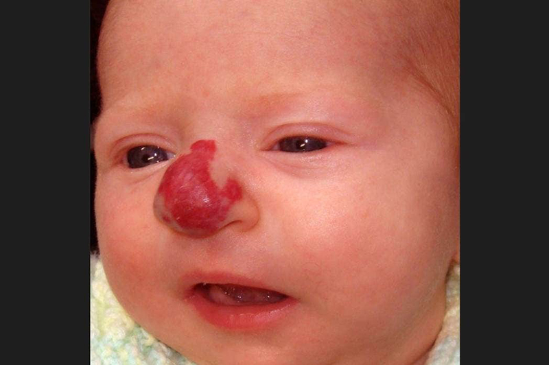 Strawberry birthmark