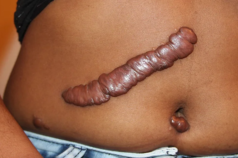 keloid scar