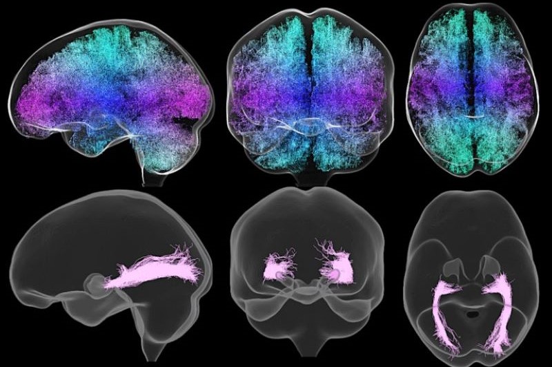 MRI eye/brain scans