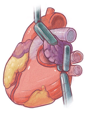 heart surgery illustration