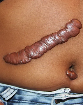 keloid scar