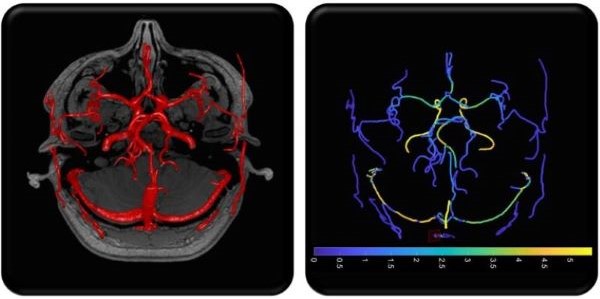Visualising brain blood flow