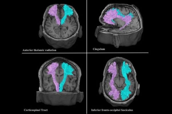 White matter fibre tracts